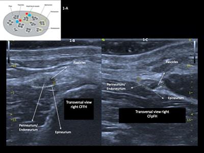 Point-of-care ultrasound of peripheral nerves in the diagnosis of Hansen's disease neuropathy